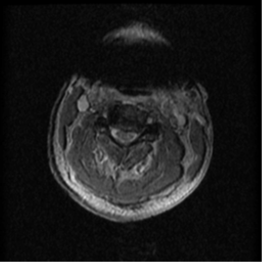 Cervical canal stenosis with cord compression (Radiopaedia 34114-35374 Axial Gradient Echo 66).png