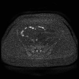 Cervical carcinoma (Radiopaedia 85405-101028 Axial DWI 77).jpg