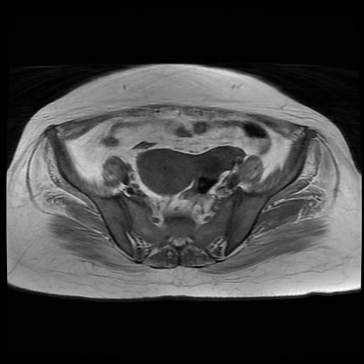 File:Cervical carcinoma (Radiopaedia 88010-104555 Axial T1 6).jpg