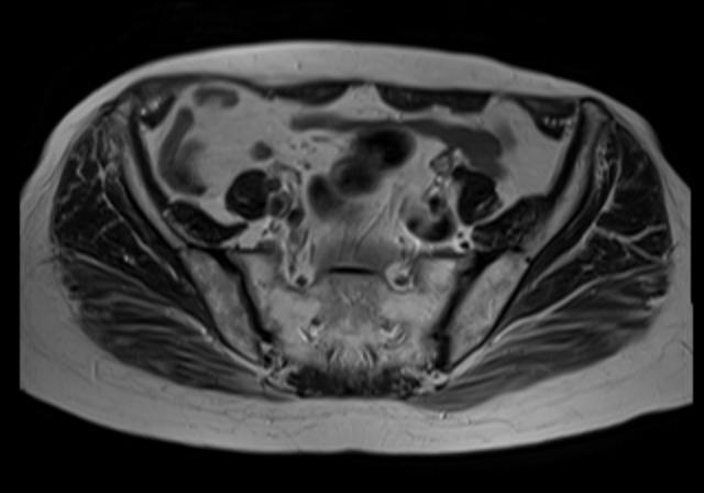 File:Cervical carcinoma (Radiopaedia 88312-104943 Sagittal T1 7).jpg