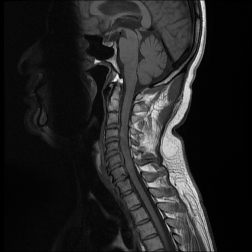 File:Cervical disc extrusion (Radiopaedia 59074-66364 Sagittal T1 6).jpg