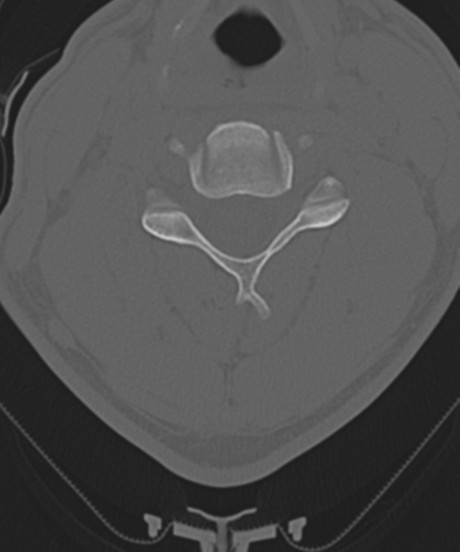 Cervical intercalary bone (Radiopaedia 35211-36748 Axial bone window 34).png