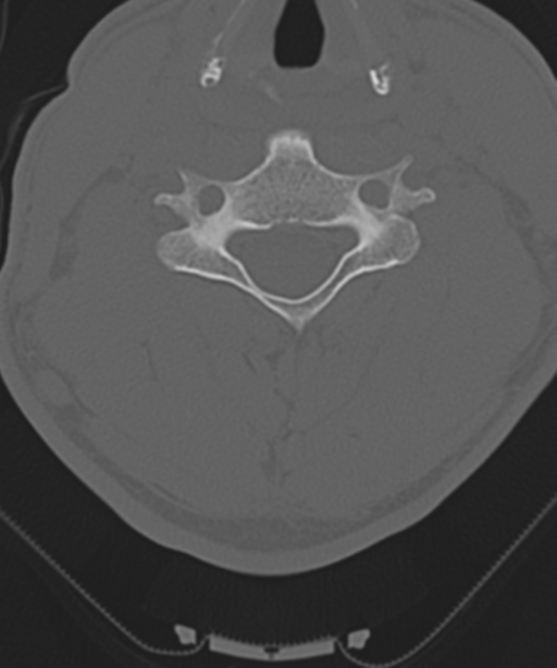 Cervical intercalary bone (Radiopaedia 35211-36748 Axial bone window 38).png