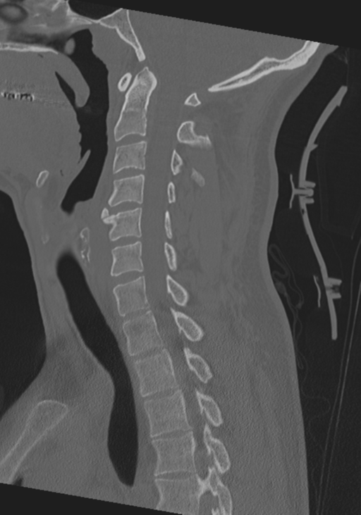 Cervical intercalary bone (Radiopaedia 35211-36748 Sagittal bone window 43).png