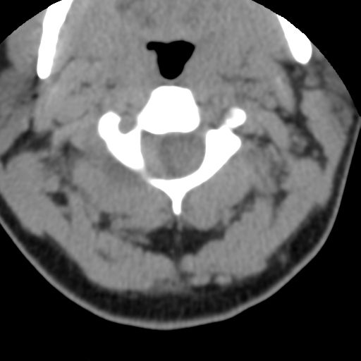File:Cervical schwannoma (Radiopaedia 57979-64974 Axial non-contrast 21).png