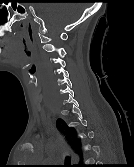 Cervical tuberculous spondylitis (Radiopaedia 39149-41365 Sagittal bone window 44).png