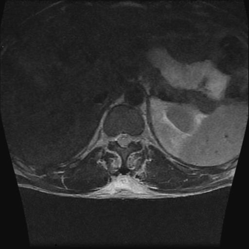 File:Chance type fracture (Radiopaedia 31020-31725 Axial T2 21).jpg