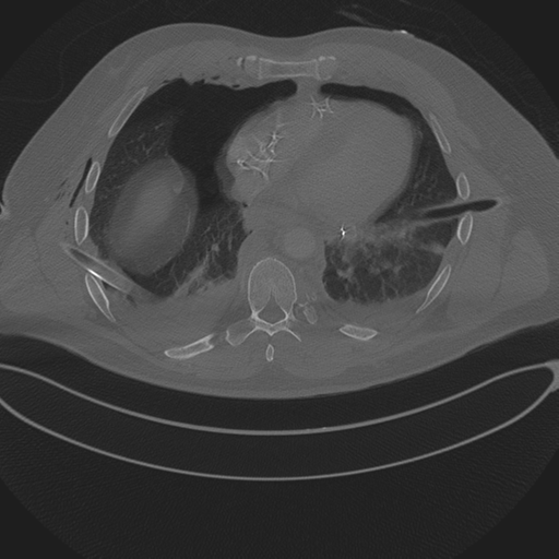 File:Chest multitrauma - aortic injury (Radiopaedia 34708-36147 Axial bone window 198).png