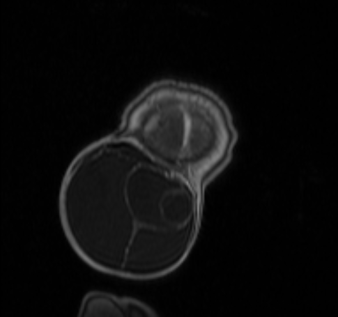 Chiari III malformation with occipital encephalocele (Radiopaedia 79446-92559 Coronal T1 C+ mpr 51).jpg