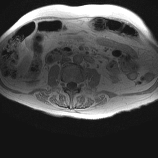 File:Cholangiocarcinoma - mass-forming pattern (Radiopaedia 16017-15677 T1 in-phase 26).jpg