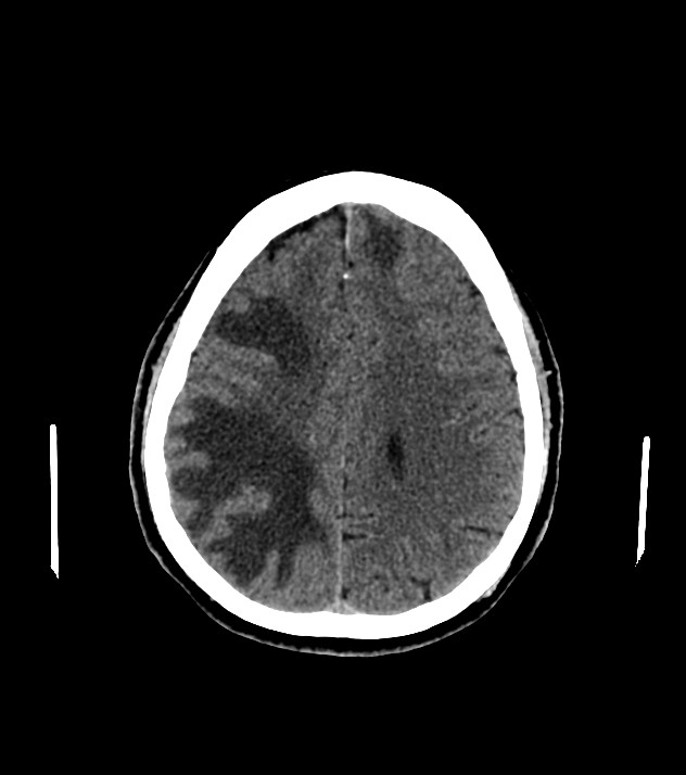 Cholangiocarcinoma with cerebral metastases (Radiopaedia 83519-98628 Axial non-contrast 47).jpg