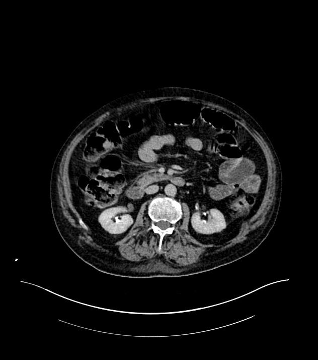 Cholangiocarcinoma with cerebral metastases (Radiopaedia 83519-98629 Axial C+ delayed 52).jpg