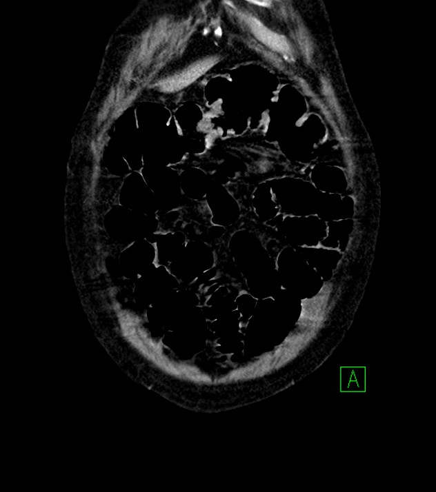 Cholangiocarcinoma with cerebral metastases (Radiopaedia 83519-98629 G 9).jpg