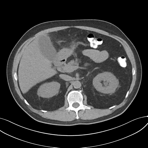 Cholecystitis with focal perforation and hepatic abscess (Radiopaedia 37189-38945 Axial non-contrast 29).png