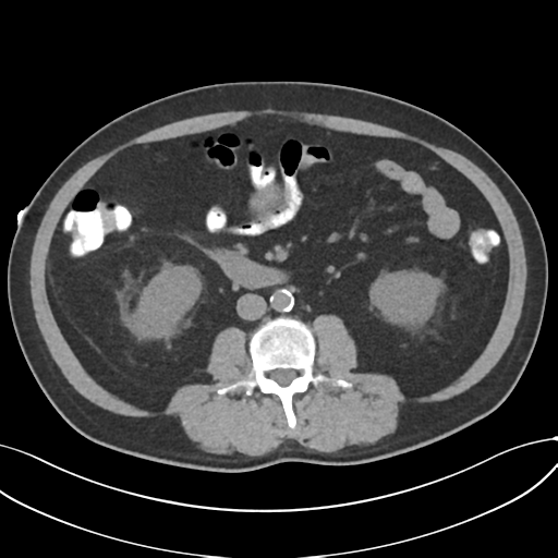 File:Cholecystitis with focal perforation and hepatic abscess (Radiopaedia 37189-38945 Axial non-contrast 44).png