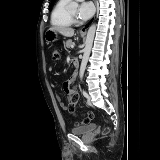 Choledocholiathiasis with normal caliber common bile duct (Radiopaedia 75368-86632 D 91).jpg