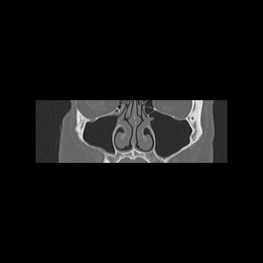 Cholesteatoma (Radiopaedia 84946-100455 Coronal bone window 36).jpg