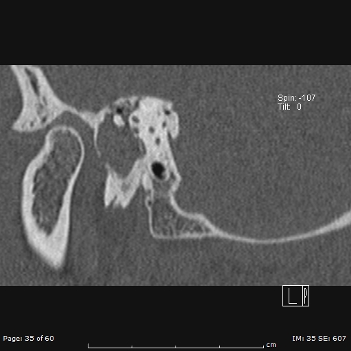Cholesteatoma - external auditory canal (Radiopaedia 88452-105096 Sagittal bone window 35).jpg