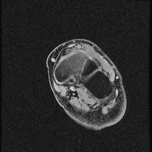 File:Chondroblastoma - midfoot (Radiopaedia 64831-73765 F 12).jpg