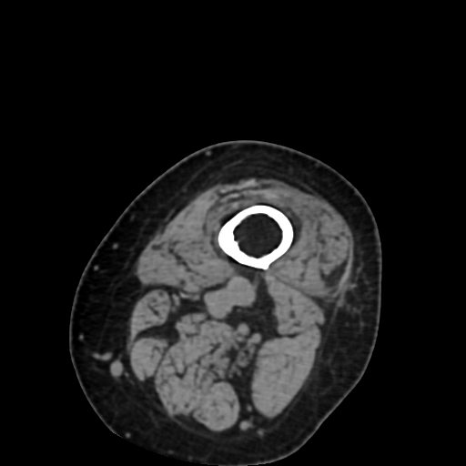 File:Chondrosarcoma - femur (Radiopaedia 64187-72954 Axial non-contrast 2).jpg