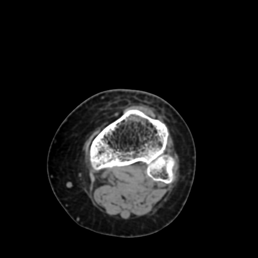 Chondrosarcoma - femur (Radiopaedia 64187-72954 Axial non-contrast 70).jpg