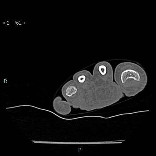 Chondrosarcoma - phalanx (Radiopaedia 69047-78812 Axial bone window 16).jpg