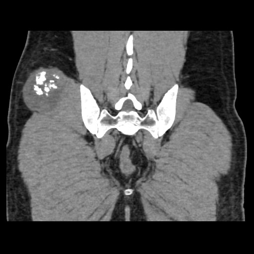 File:Chondrosarcoma of iliac wing (Radiopaedia 63861-72599 Coronal non-contrast 92).jpg