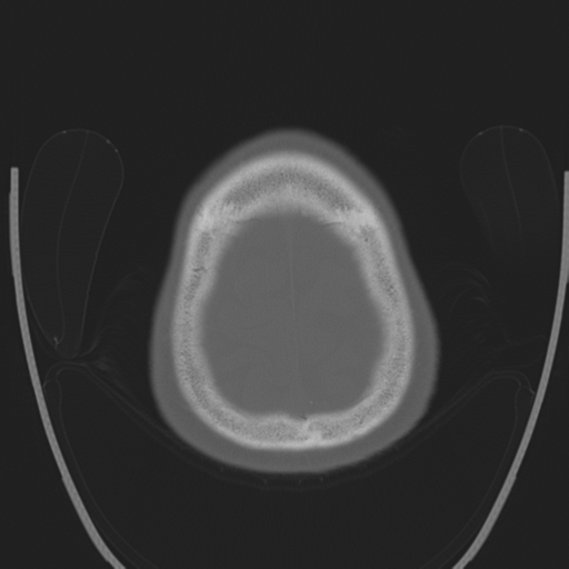 Chondrosarcoma of skull base- grade II (Radiopaedia 40948-43653 Axial bone window 45).png