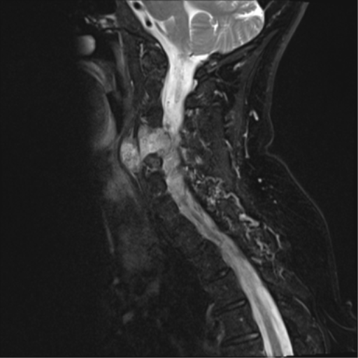 File:Chordoma (C4 vertebra) (Radiopaedia 47561-52189 Sagittal T2 fat sat 9).png