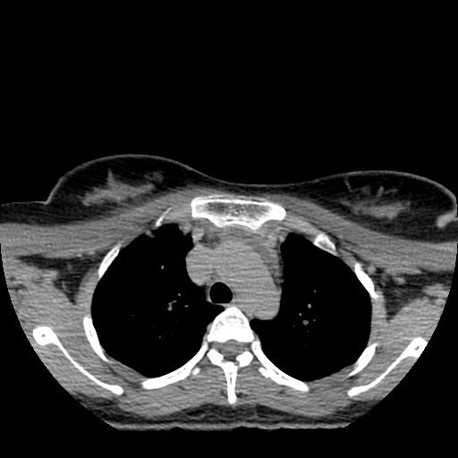 File:Choriocarcinoma of ovary with cerebral and pulmonary metastases (Radiopaedia 25983-26119 Axial non-contrast 106).jpg