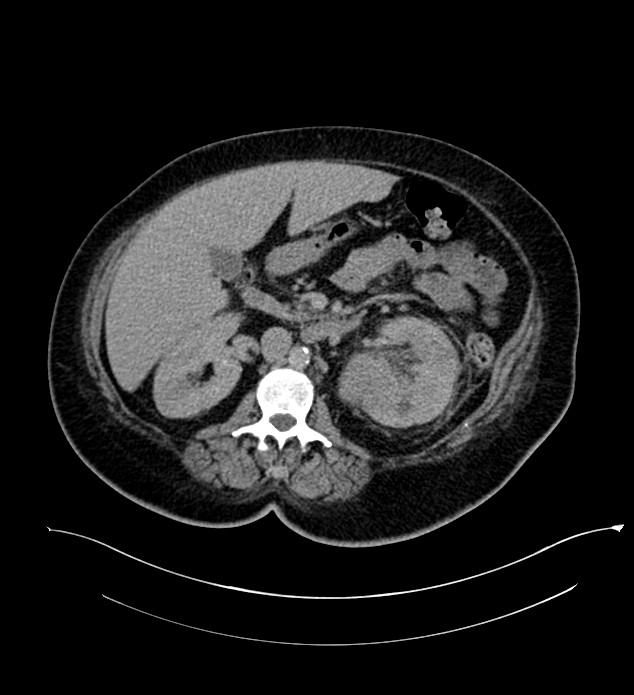 Chromophobe renal cell carcinoma (Radiopaedia 84239-99519 E 74).jpg