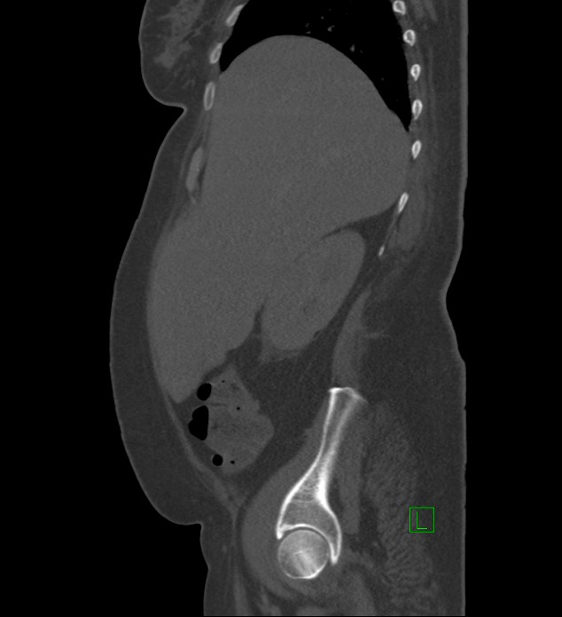 Chromophobe renal cell carcinoma (Radiopaedia 84239-99519 Sagittal bone window 83).jpg