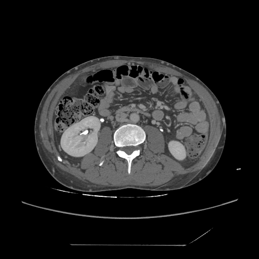File:Chronic IVC thrombosis and resultant IVC filter malposition (Radiopaedia 81158-94800 A 108).jpg