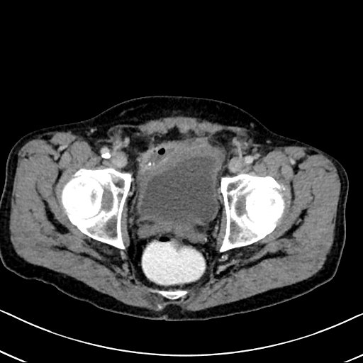 Chronic appendicitis complicated by appendicular abscess, pylephlebitis and liver abscess (Radiopaedia 54483-60700 B 135).jpg