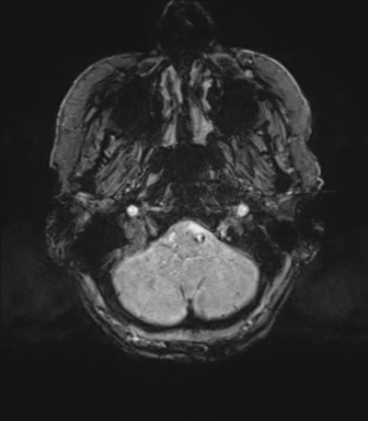 Chronic hypertensive encephalopathy (Radiopaedia 72844-83495 Axial SWI magnitude 9).png