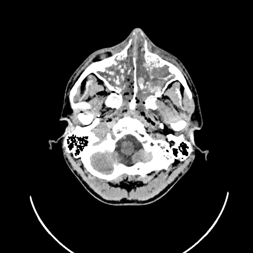 Chronic invasive fungal sinusitis (Radiopaedia 50342-55710 Axial non-contrast 24).jpg