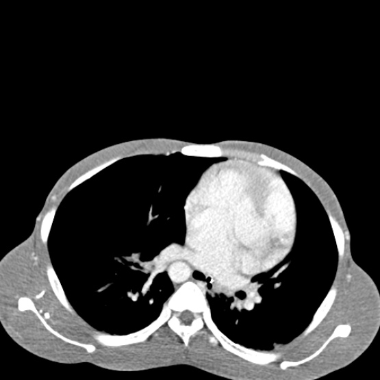 Chronic large bowel pseudo-obstruction (Radiopaedia 43181-46492 A 15).jpg