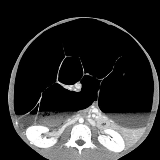 Chronic large bowel pseudo-obstruction (Radiopaedia 43181-46492 A 89).jpg