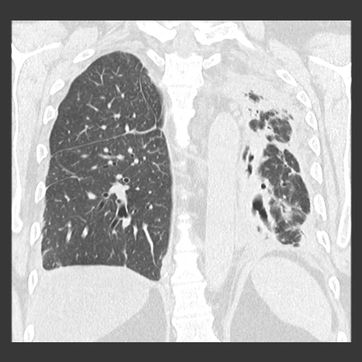 File:Chronic lung allograft dysfunction - restrictive form (Radiopaedia 60595-68316 Coronal lung window 69).jpg