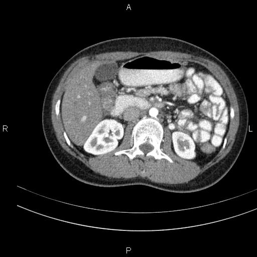 File:Chronic pancreatitis (Radiopaedia 64576-73450 B 67).jpg