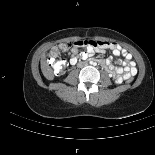 Chronic pancreatitis (Radiopaedia 64576-73450 B 93).jpg