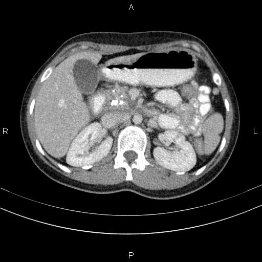 File:Chronic pancreatitis (Radiopaedia 64576-73450 C 51).jpg