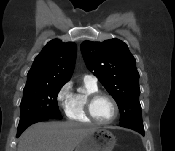 Chronic pulmonary embolus (Radiopaedia 39129-41341 Coronal C+ CTPA 29).png