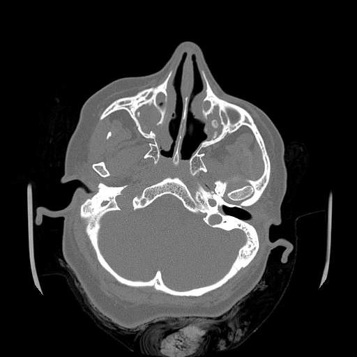 Chronic sinusitis with intra-sinus calcification (Radiopaedia 63919-72668 Axial bone window 49).jpg