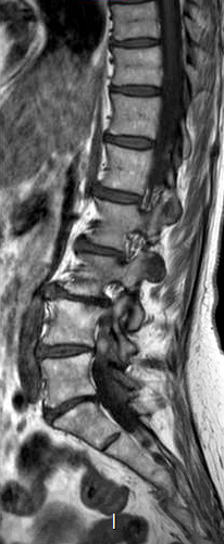 File:Chronic spinal hematoma with cauda equina syndrome (Radiopaedia 75745-87090 Sagittal T1 10).png
