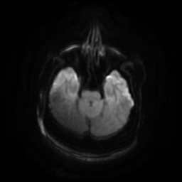 File:Chronic submandibular sialadenitis (Radiopaedia 61852-69885 Axial DWI 1).jpg