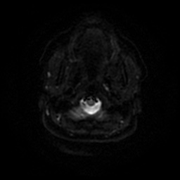 File:Chronic submandibular sialadenitis (Radiopaedia 61852-69885 Axial DWI 38).jpg