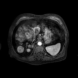 Cirrhosis and hepatocellular carcinoma in the setting of hemochromatosis (Radiopaedia 75394-86594 Axial T1 C+ fat sat 138).jpg