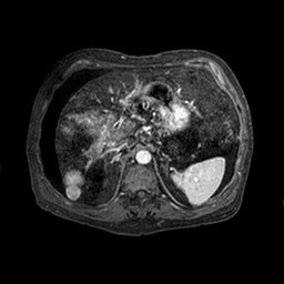 Cirrhosis and hepatocellular carcinoma in the setting of hemochromatosis (Radiopaedia 75394-86594 Axial T1 C+ fat sat 219).jpg