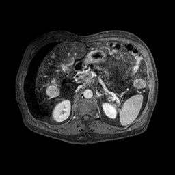 Cirrhosis and hepatocellular carcinoma in the setting of hemochromatosis (Radiopaedia 75394-86594 Axial T1 C+ fat sat 296).jpg